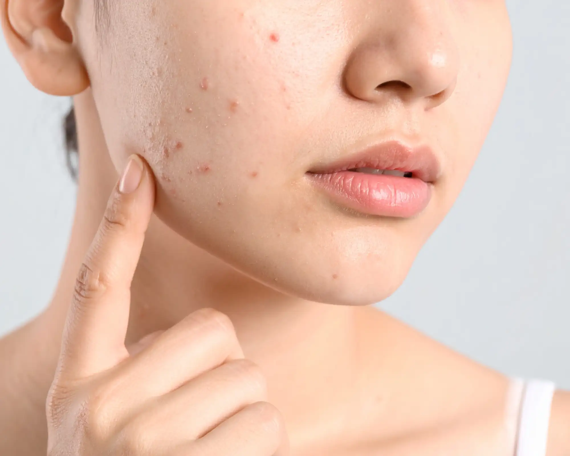 Ακμή; Η Ρουτίνα Περιποίησης που Λατρεύει το Δέρμα σου